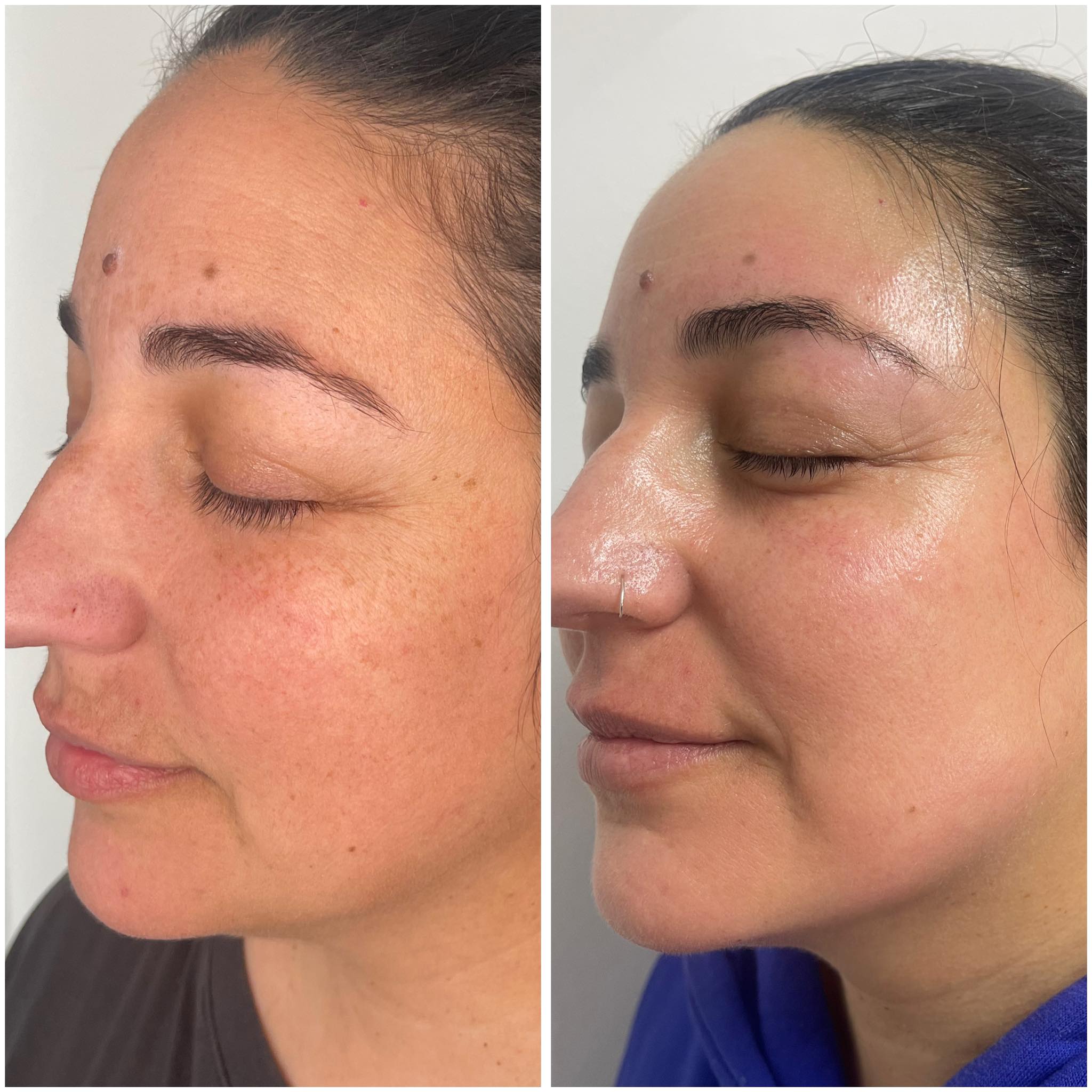 antes y despues tratamiento-facial-centro-belleza-juany